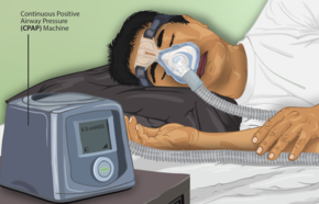 استفاده از CPAP برای درمان