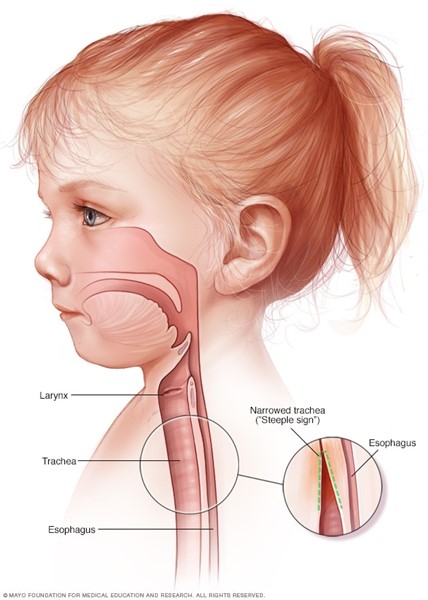 مسیر تنفسی کودک در اثر بیماری خروسک Croup