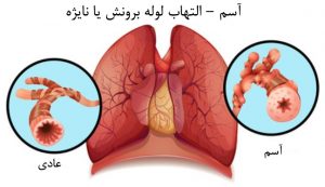 التهاب راه‌های هوایی ناشی از آسم