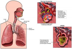 در سندرم دیسترس تنفسی حاد تجمع مایع در کیسه‌های هوایی مانع تبادل گازی مؤثر با خون می‌گردد