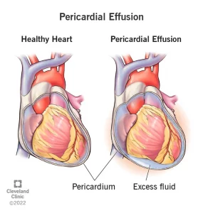 در افیوژن پریکارد با تامپوناد (Pericardial effusion with tamponade) باعث مایع در اطراف کیسه‌ای است که قلب را می‌پوشاند جمع می‌شود