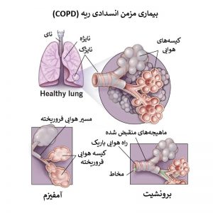 در بیماری انسدادی مزمن ریه، بازدم تمام هوای درون ریه‌ها به دلیل آسیب ریه، دشوار است