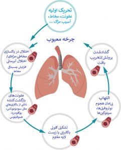 چرخه معیوب برونشکتازی