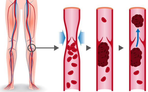 لخته شدن خون در ورید عمقی - معمولاً در ساق پا، لگن یا بازو رخ می‌دهد