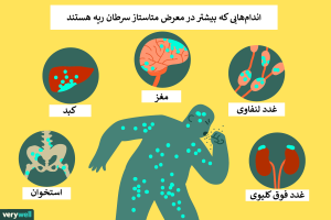 رطان ریه چقدر سریع پخش می‌شود؟