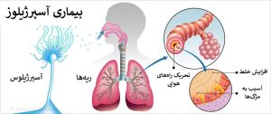 آسپرژیلوس، بیماری آسپرژیلوز، علل و درمان