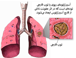 آسپرژیلوس، بیماری آسپرژیلوز، علل و درمان