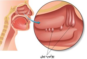احتقان یا گرفتگی بینی