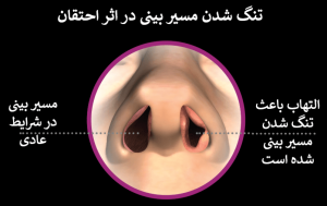 احتقان بینی زمانی رخ می‌دهد که عاملی باعث تحریک بافت‌های پوشاننده داخل بینی شامل رگ‌های خونی و غشاهای مخاطی در سینوس‌ها و مجاری بینی متورم شود. 