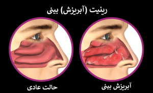 احتقان بینی و آبریزش