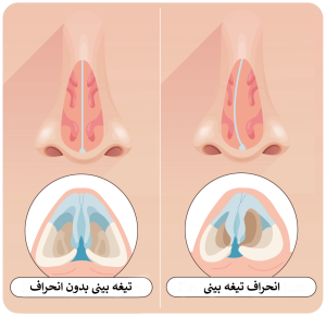 انحراف بینی
