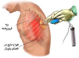 پنوموتوراکس یا فروپاشی ریه، علل و درمان